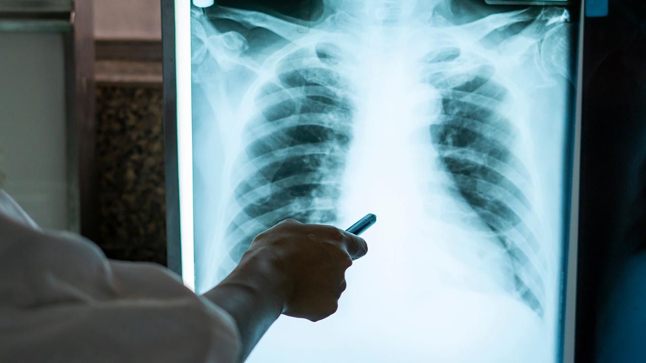 Powstał najdokładniejszym jak dotąd obraz zmian w płucach po infekcji SARS-CoV-2 (fot. Shutterstock/Chokii.Ns)